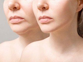 How to Combine Botox, Fillers, and Morpheus8 for Best Results